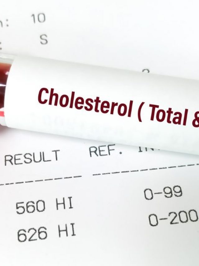 Why Does Cholesterol Matter So Much, and In What Ways Does Nursing Care Play an Important Role?